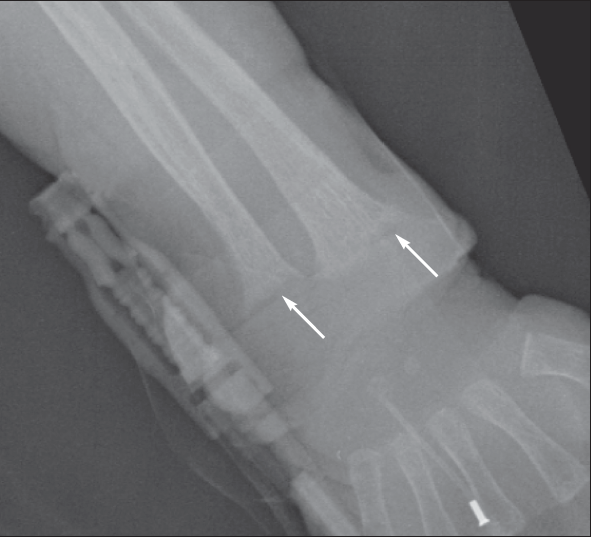 Vitamin D Deficiency Rickets Consultant360